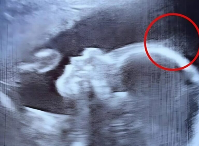Les médecins n’en croyaient pas leurs yeux lors de l’échographie – maintenant, ce bébé gagne les cœurs partout où il passe