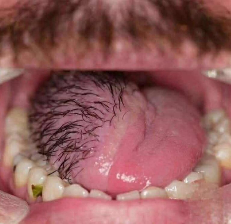 Este estado de «lengua peluda» es real y puede aparecer cuando…