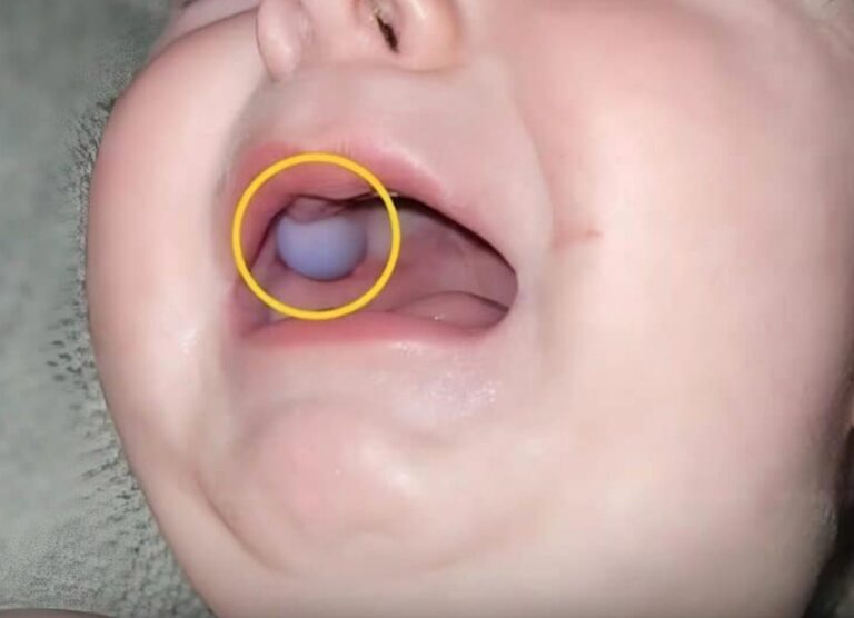 Un simple regard dans la bouche de son bébé de neuf mois a poussé la mère à consulter en urgence. Ce que les médecins ont découvert a stupéfié tout le monde.